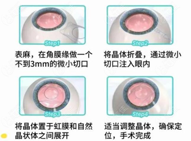 合肥科大眼科医院做晶体植入的手术优势