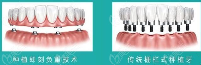 <!--<i data=20240703-sp></i>-->医院种植牙收费m.236z.com