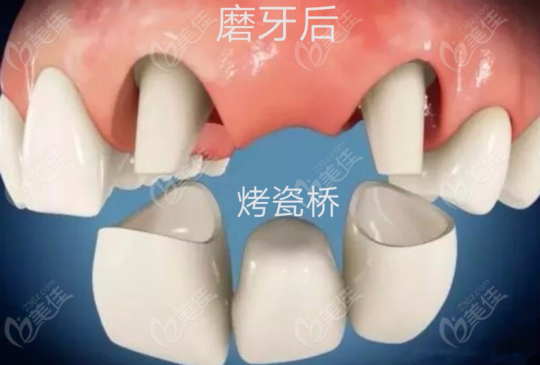 西宁时光口腔医院烤瓷牙费用