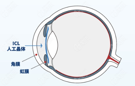 ICL晶体植入手术全过程