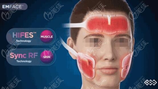 MFACE一个疗程结果维持时间要多久m.236z.com
