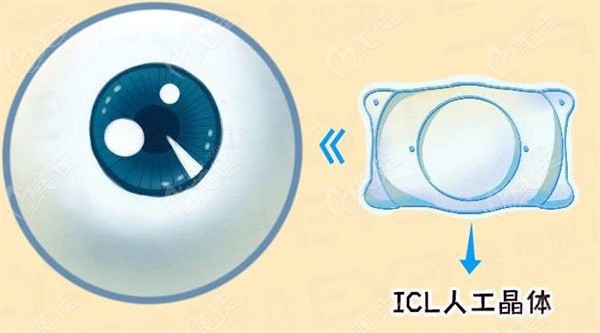 icl晶体植入