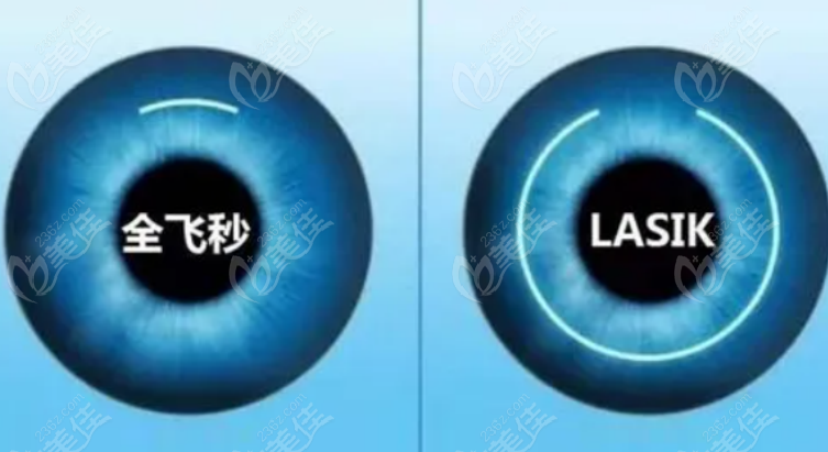 屈光手术