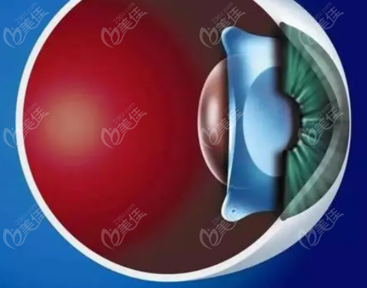 屈光手术