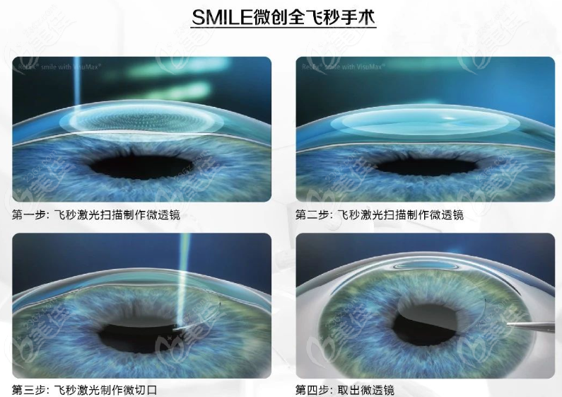 成都全飞秒近视手术医院哪家好
