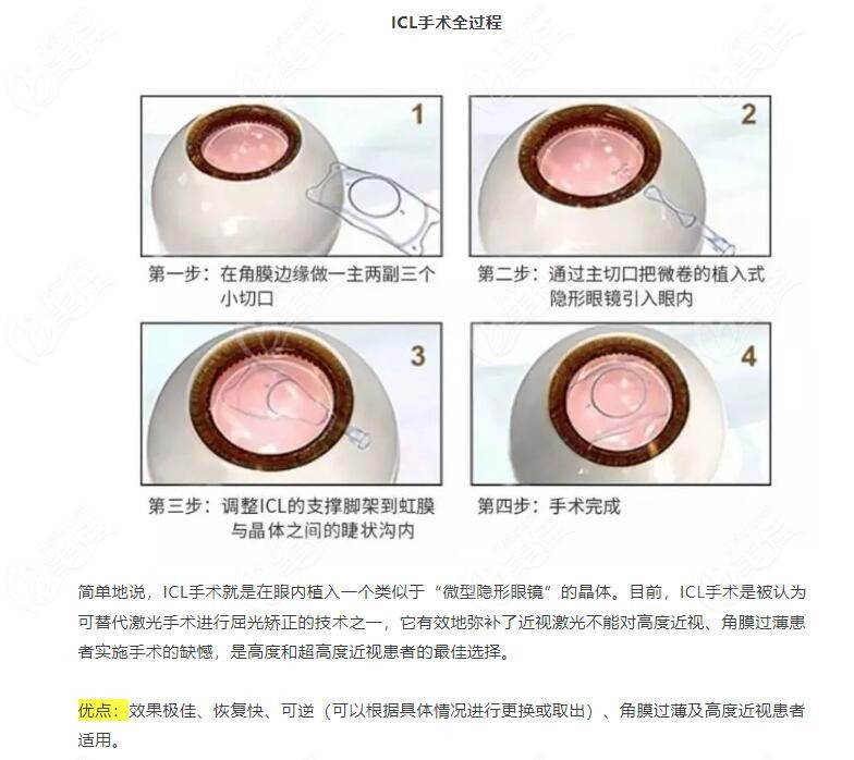 icl晶体植入手术过程