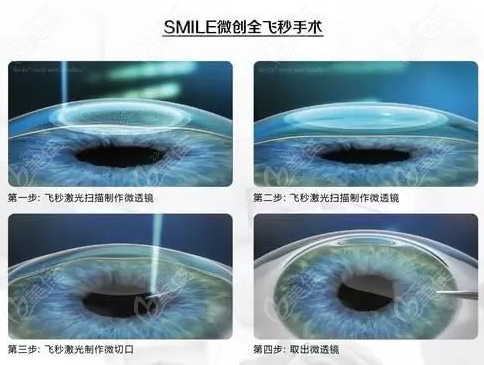 <!--<i data=20240703-sp></i>-->和平眼科全飞秒近视手术做的好