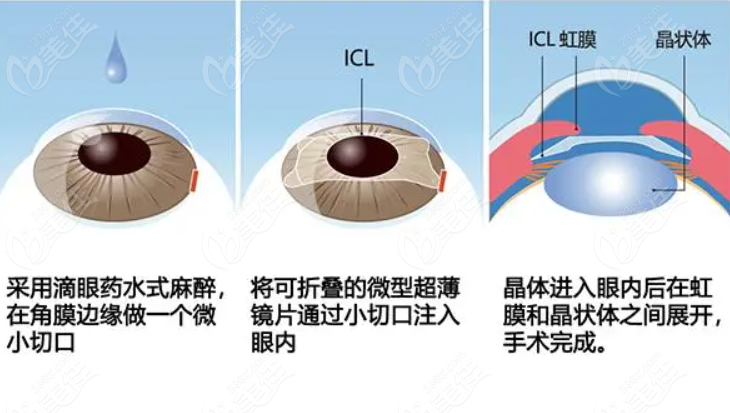 ICL晶体植入手术流程