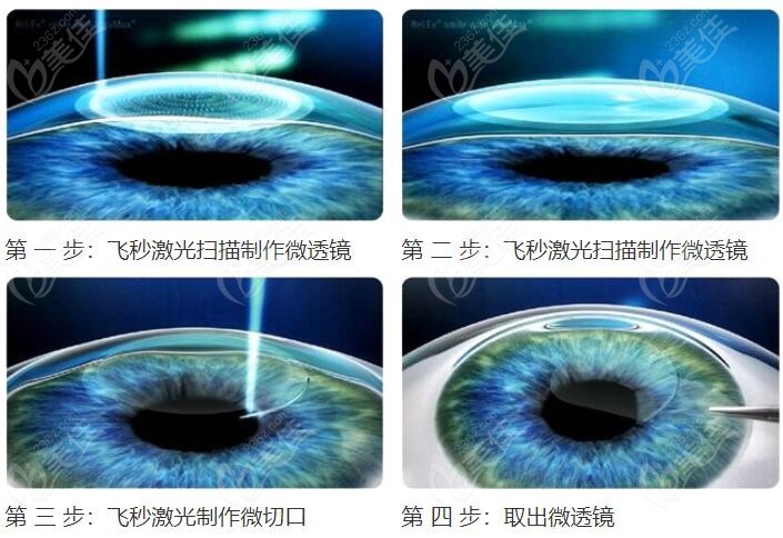 普瑞眼科全飞秒激光近视手术过程