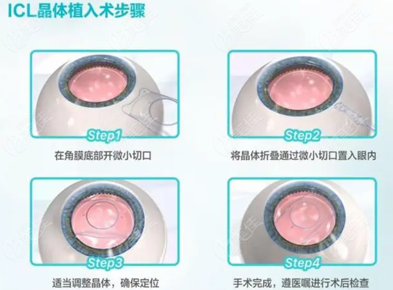 武汉佰视佳眼科周跃明icl晶体植入过程