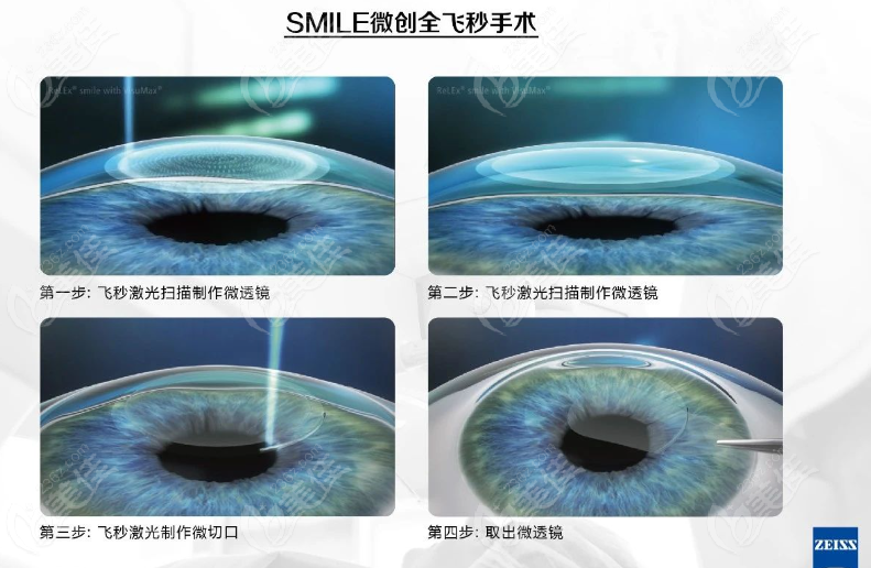 上海新视界眼科医院李海燕激光近视眼手术怎么样