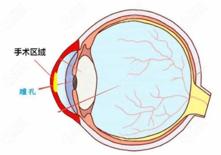 暗瞳大不能做全飞秒手术