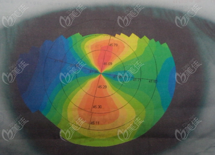 角膜地形图
