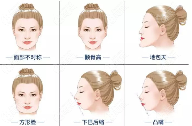 罗恩和叶斌正颌手术价格哪个贵