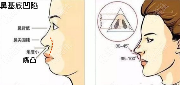 ADM填充鼻基底材料优缺点解析