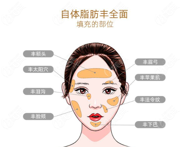 自体脂肪填充眉弓怎么样