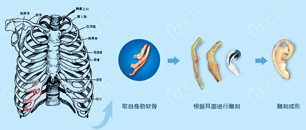 庄洪兴肋软骨耳再造过程