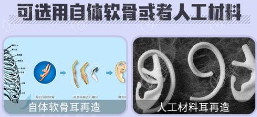 余文林可做肋软骨、人工支架耳再造