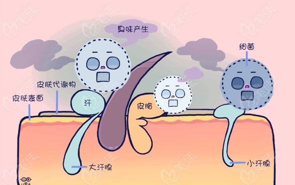 广州狐臭手术哪家医院好