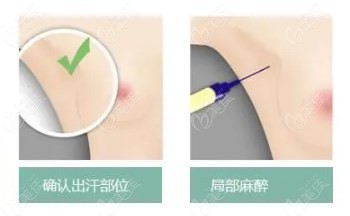 广州韩妃去狐臭手术方式