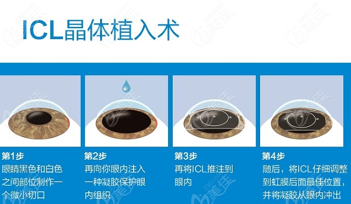 <!--<i data=20240703-sp></i>-->眼科医院晶体植入近视手术过程