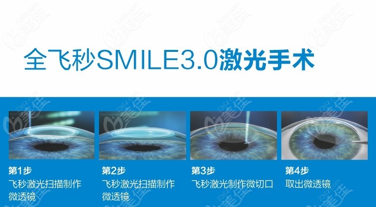 <!--<i data=20240703-sp></i>-->眼科医院做蔡司smile全飞秒激光手术过程236z.com