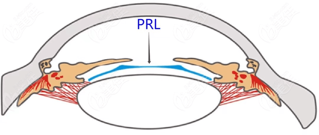 什么是PRL悬浮镜晶体植入近视手术