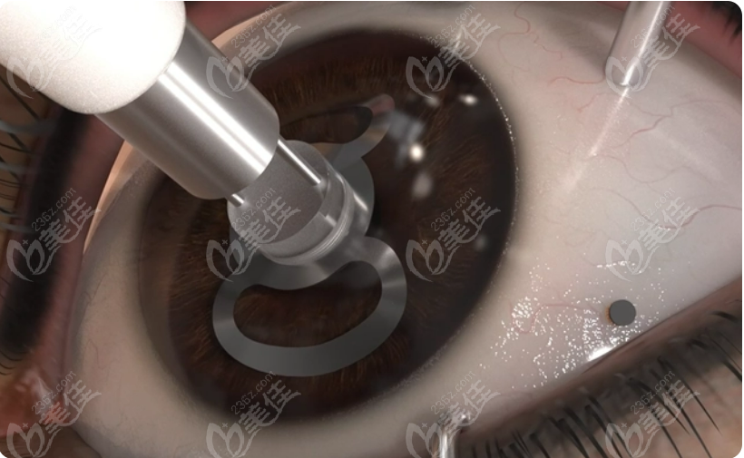 2广州爱尔眼科角膜移植费用：45800元起；