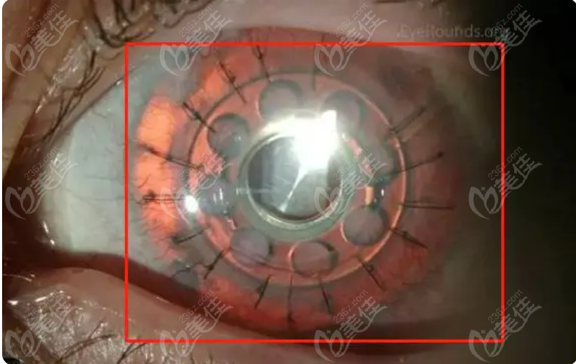 爱尔眼科穿透角膜移植价格：45000元起一只；