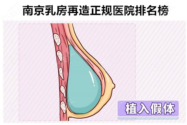 南京乳房再造正规医院排名榜