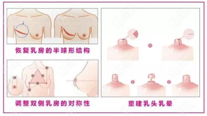 南京乳房重建哪家医院技术好——推荐南京友谊整形