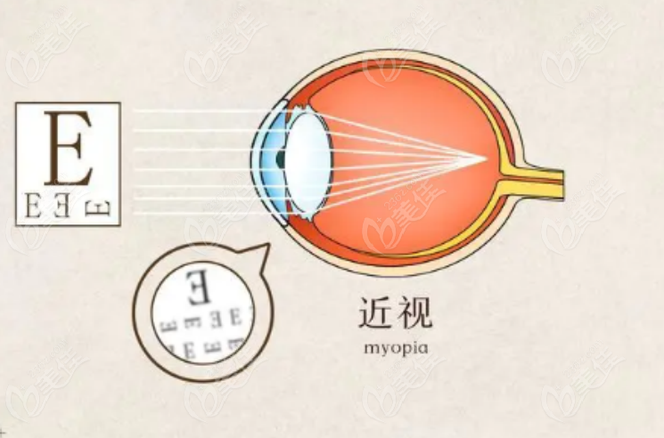 普瑞眼科做近视眼好的医生