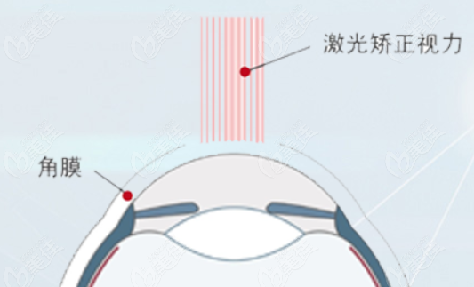 深圳友华普惠眼科做蔡Smart全激光近视手术