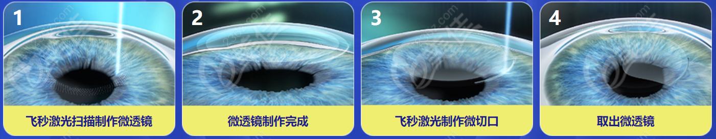 深圳友华普惠眼科做蔡司3.0全飞秒激光近视手术好
