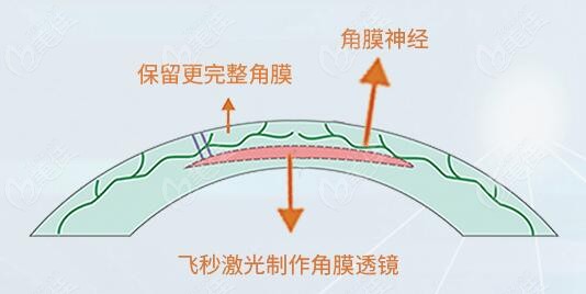 蔡司3.0全飞秒手术
