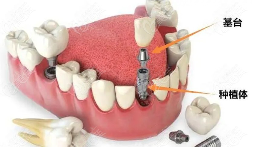 吴忠牙卫士口腔种植牙项目