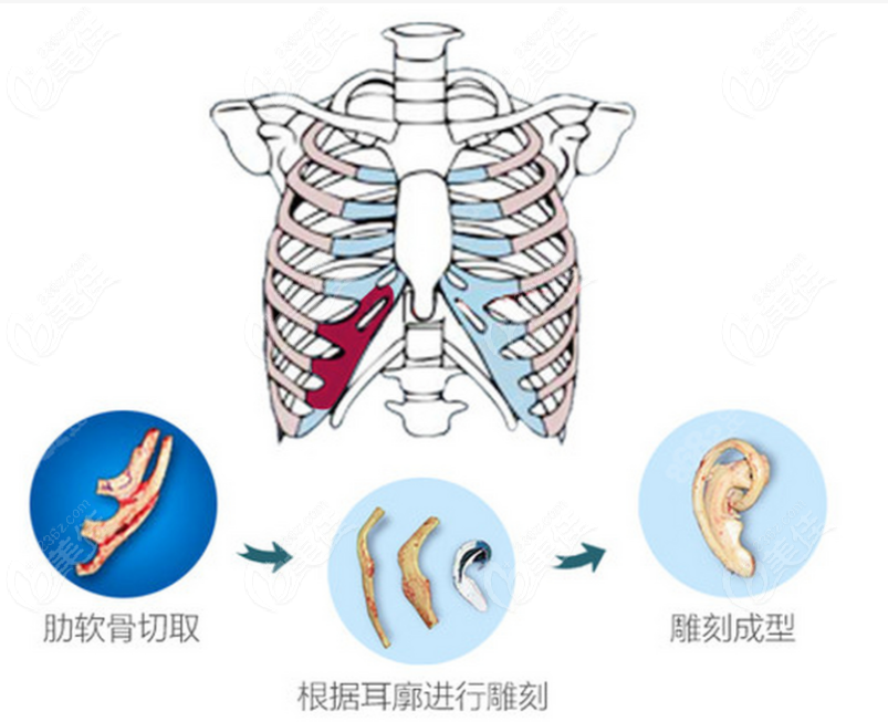 耳再造手術(shù)肋軟骨雕刻過程