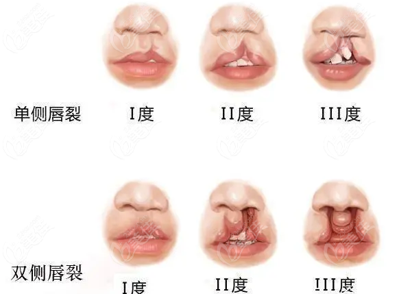 余文林修复唇裂全部范例之单侧唇裂术后鼻畸形修复范例
