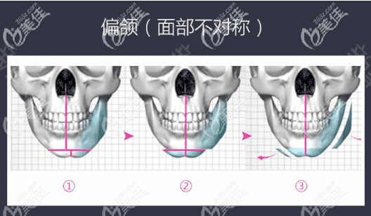 广州广大医院正颌手术范例图片之偏颌