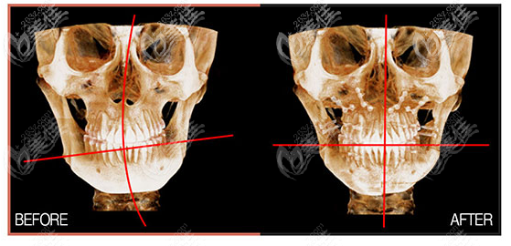广州广大医院正颌手术范例图片之面部不对称