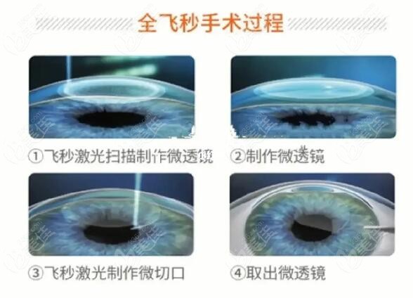 全飞秒激光手术过程