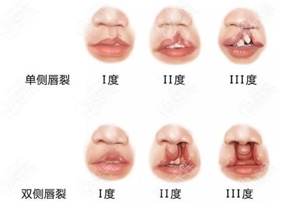 广西唇腭裂定点医院排名名单