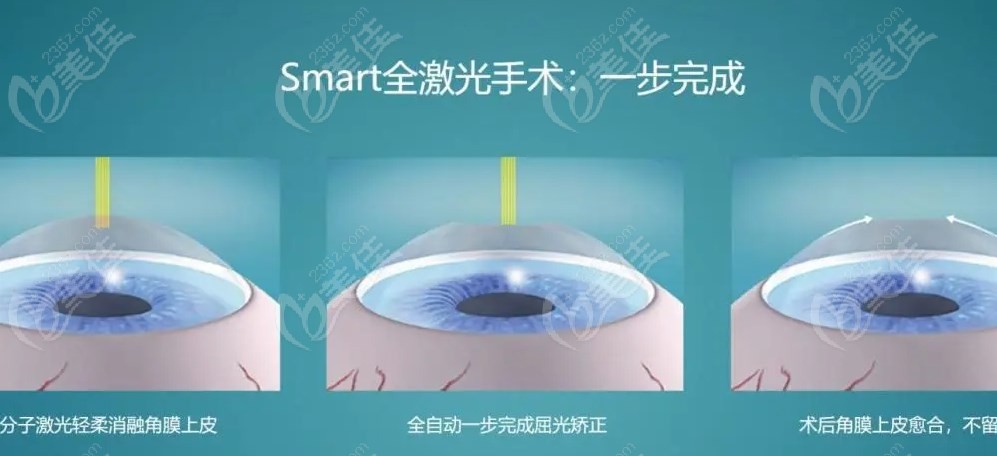 Smart全激光近视手术