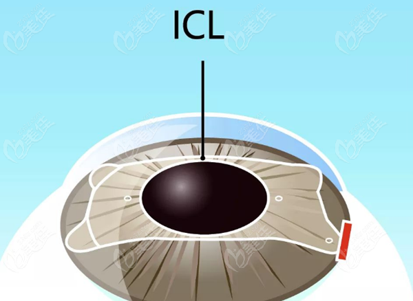 兰州ICL晶体植入手术
