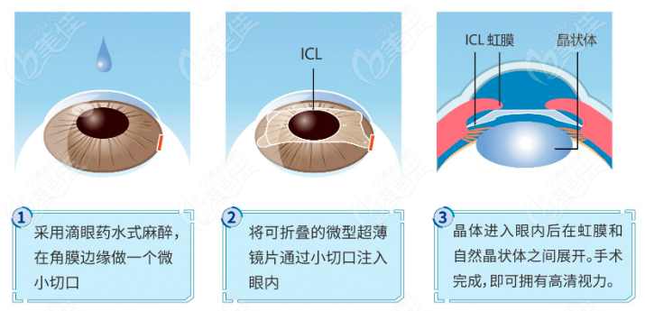 西安晶体植入近视眼手术价格