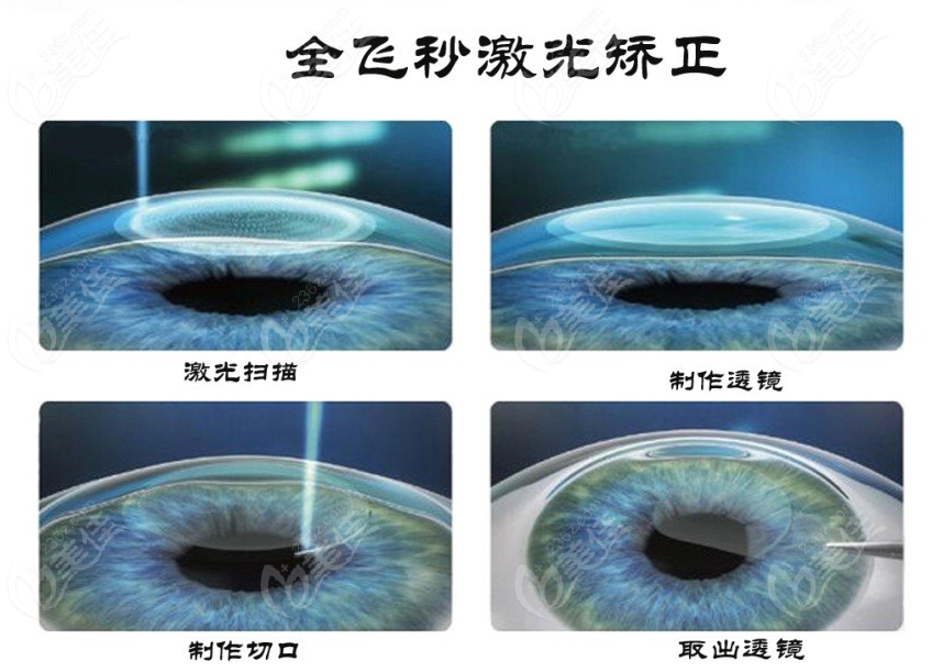 南昌全飛秒手術(shù)價格一般在15000-20000元左右