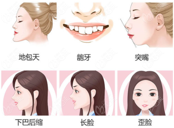 <!--<i data=20240703-sp></i>-->医生正颌手术怎么样