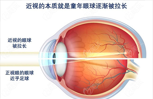 先天性近視可以做手術(shù)嘛