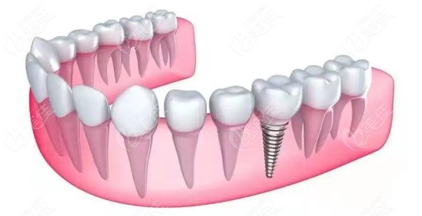 2023后槽牙种植牙价格表