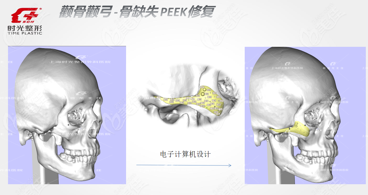 何晋龙peek人工骨修复颧骨价格和图片